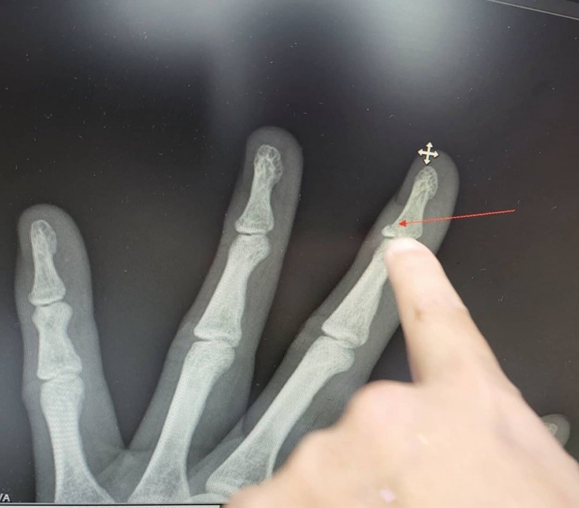 CNBLUE Minhyuk's broken finger