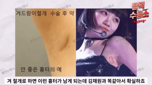 LE SSERAFIM Kim Chaewon suspects plastic surgery of the chest