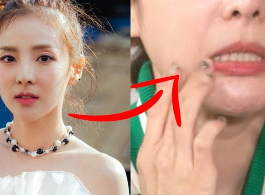 Sandara Confesses Side Effects After She Did THIS To Face– What Happened?